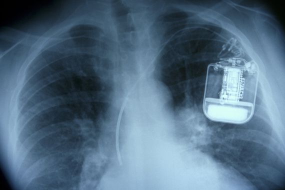 Lung X-Ray showing Pacemaker